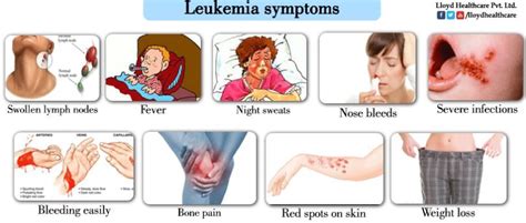 Acute Lymphoblastic Leukemia Symptoms - Latest Health News ...