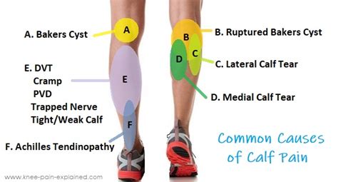 Blood Clot In Calf Of Leg Symptoms Deep Vein Thrombosis Dvt