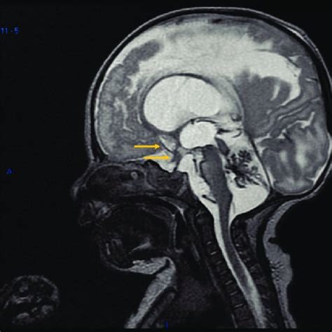 Brain Us On Dol 7 Showing Bilateral Grade 3 Ivh Us Ultrasound Dol