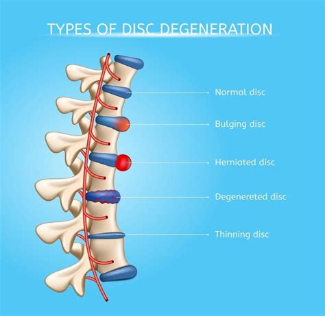 Causes Of And Chiropractic Treatments For A Bulging Disc Ward