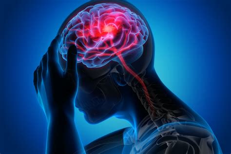 Accident vasculaire cérébral AVC symptômes définition signes