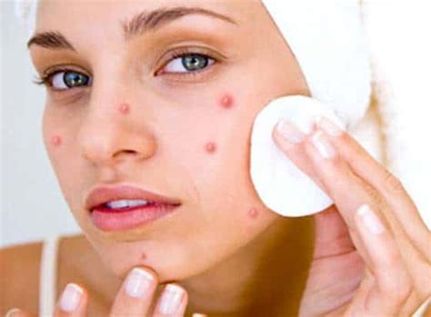 30 Expert Tips To Get Rid Of Acne Faster Indian Beauty Tips
