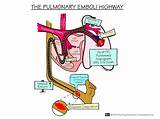 Pictures of Medical Treatment For Pulmonary Embolism
