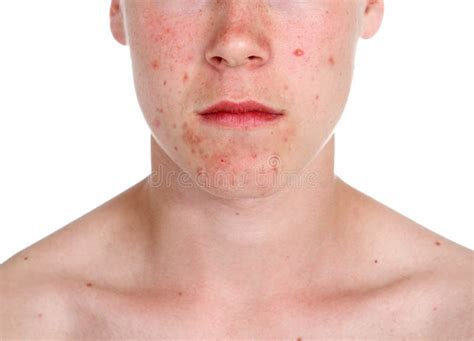Teenage Boy With Acne Stock Photo Image Of Skincare 17769488