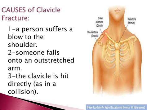 Ppt Fracture Of Clavicle And Humerus Powerpoint Presentation Free