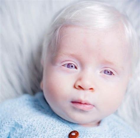 Vitiligo In Babies Pictures Takako Foy