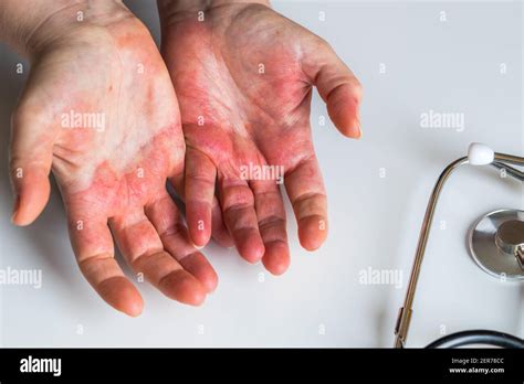 Red Itchy Hands With Blisters Atopic Dermatitis A Visit To A