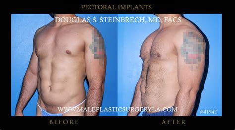 Pectoral Implants Gallery Male Plastic Surgery Los Angeles