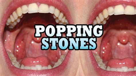 Popping Stones Popaholics Meet Jennifers Tonsil Stones Youtube