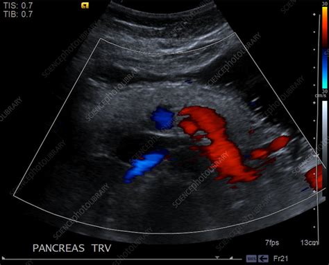 Normal Pancreas Ultrasound Stock Image C0393201 Science Photo