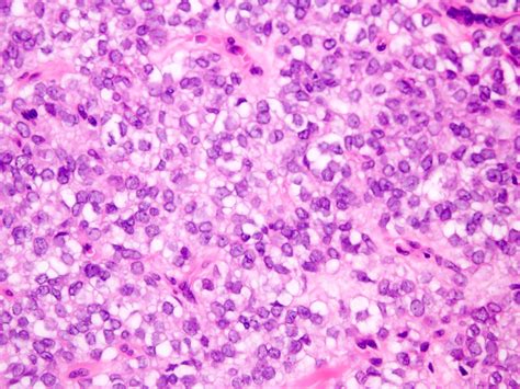 Pathology Outlines Myoepithelioma Myoepithelial Carcinoma Mixed Tumor
