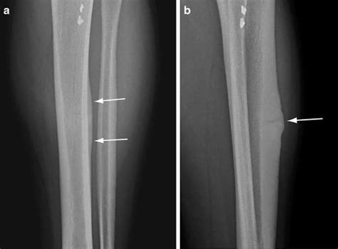Imaging Of Stress Fractures Musculoskeletal Key