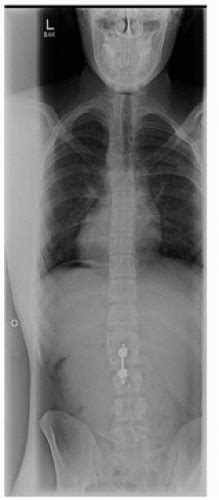 Hemivertebrae Excision Posterior Only Approach Musculoskeletal Key