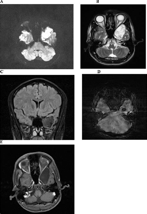 Figure 1 From Intracranial Epidermoid Cyst A Rare Case Series Of 3