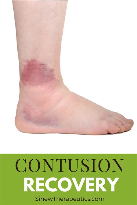 Pin On Contusion