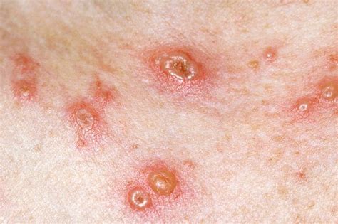 Viral Infections As Related To Chickenpox Pictures