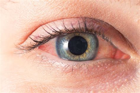 Occhio Secco Sintomi Tipologie Diagnosi E Cura