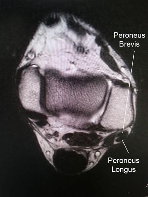 Peroneal Tendon Tears And Instability Foot And Ankle Orthobullets