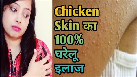 स्किन पर छोटे छोटे से दाने हैंchicken Skin Treatment In Hindi