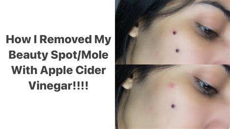 How I Removed My Beauty Spotmole At Home With Apple Cider Vinegar