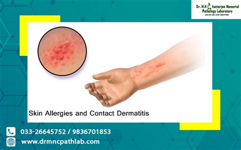 Skin Allergies And Contact Dermatitis Dr Mn Chatterjee Pathology