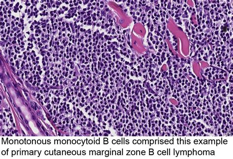 Pathology Outlines Primary Cutaneous Marginal Zone Lymphoma