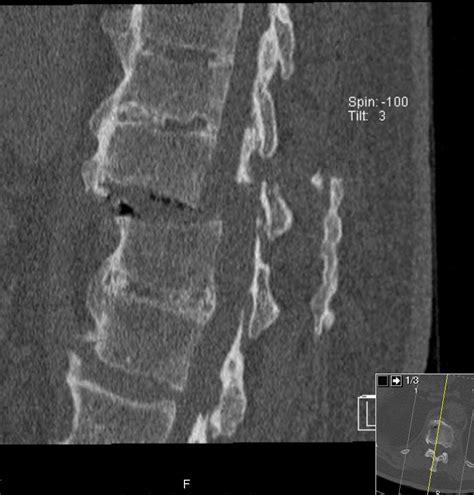 Frattura Vertebrale tipo B 1.1.3 di Magerl-Aebi in ...