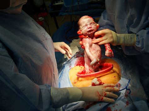This is the most common complication of a cesarean delivery and. increase in cesarean sections since 2000