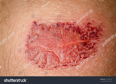 Medical Incrustation Scab Skin Of Patient Stock Photo 107534156
