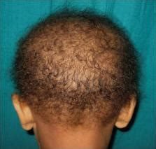 Las type a presents with sparse, short hair. Loose anagen hair syndrome - ScienceOpen
