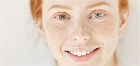 Heterochromia Causes And Types Vision Source Of Hendersonville