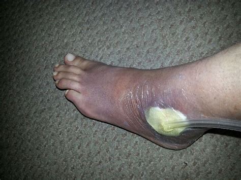 Oh, about 2 hours, said the fisherman. The horrific effects of the False Widow spider bite ...
