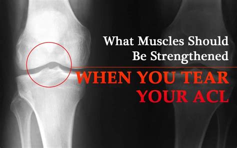 We did not find results for: What Muscles Should Be Strengthened When You Have Torn ACL ...