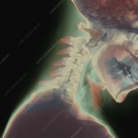 Broken Neck Stock Image M3300935 Science Photo Library