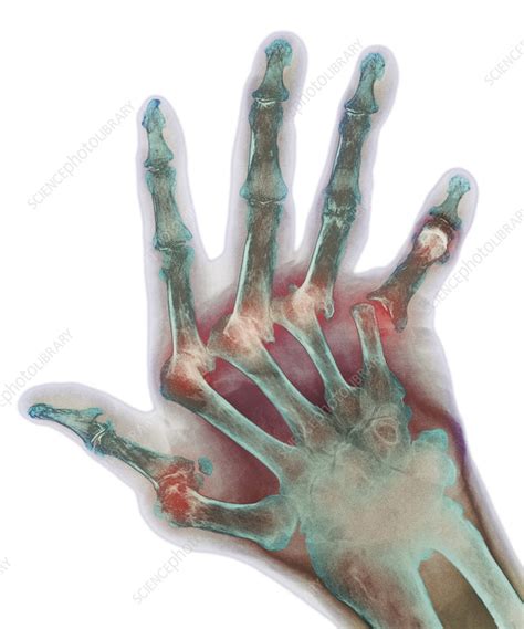 Arthritic Hand X Ray Stock Image M1100515 Science Photo Library
