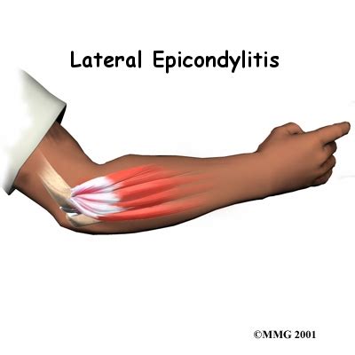 Once the initial injuries heal, these tears occur again and cause hemorrhages. Tennis Elbow (Lateral Epicondylitis). Causes, symptoms ...