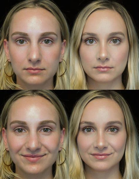 The Complete Guide To Rhinoplasty Nose Surgery Rhinoplasty