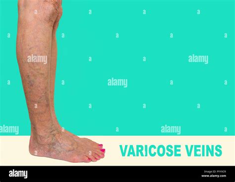 Varicose Veins On A Female Legs Stock Photo Alamy