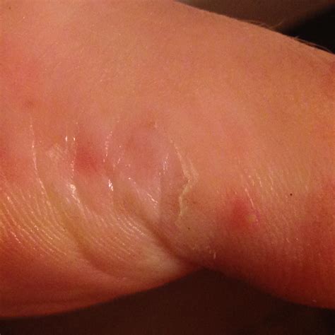 List 100+ Images Pictures Of Sun Poisoning On Skin Updated