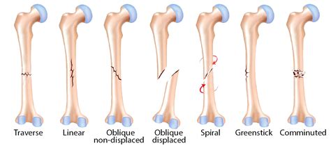 The Orthopedic Institute At Southwest Health Types Of Fractures