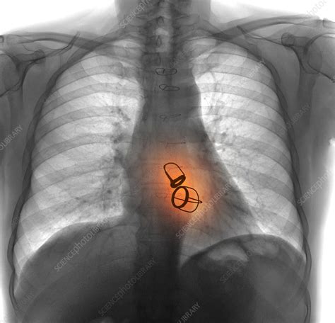 Prosthetic Heart Valves X Ray Stock Image F0083453 Science