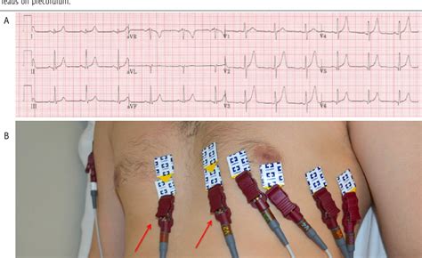Figure 3 From Common Ecg Lead Placement Errors Part Ii Precordial