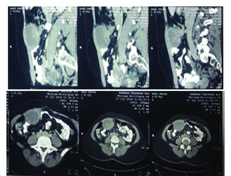 Jan hein van waesberghe, marieke hazewinkel and milou busard. Would A Ct Scan Show Endometriosis - ct scan machine