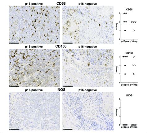 Cd68 Cd163 And Inos Expression In P16 Positive And P16 Negative