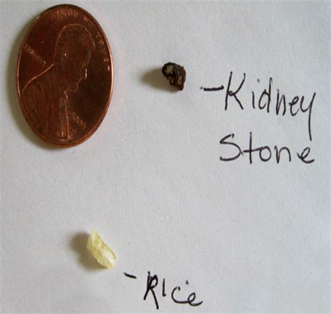 What Are Kidney Stones Causes Symptoms And Treatments
