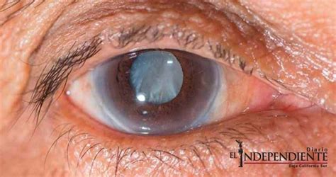 The optic nerve supplies visual information to your brain from your eyes. Glaucoma, primera causa de ceguera no reversible en México ...