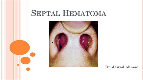 Nasal Septal Hematoma Explained For Medical Students Youtube