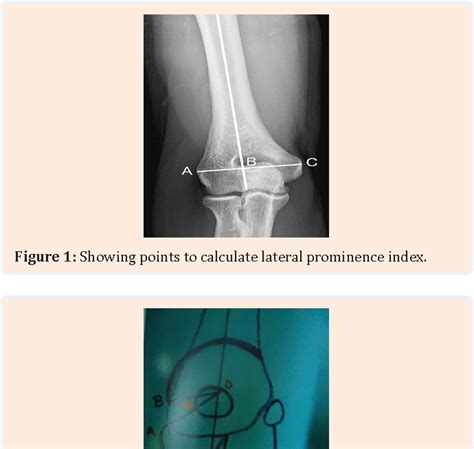 Figure 1 From Clinical Outcome Of Dome Osteotomy In Cubitus Varus