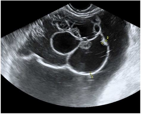 Symptoms become more noticeable as the cancer progresses. The characteristic ultrasound features of specific types ...
