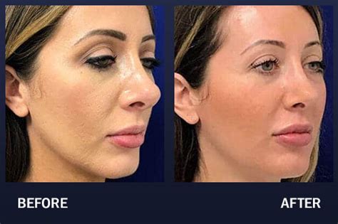 Cheek Filler Before And After Pictures Madnani Facial Plastic Surgery